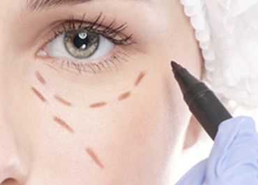 Blefaroplastia